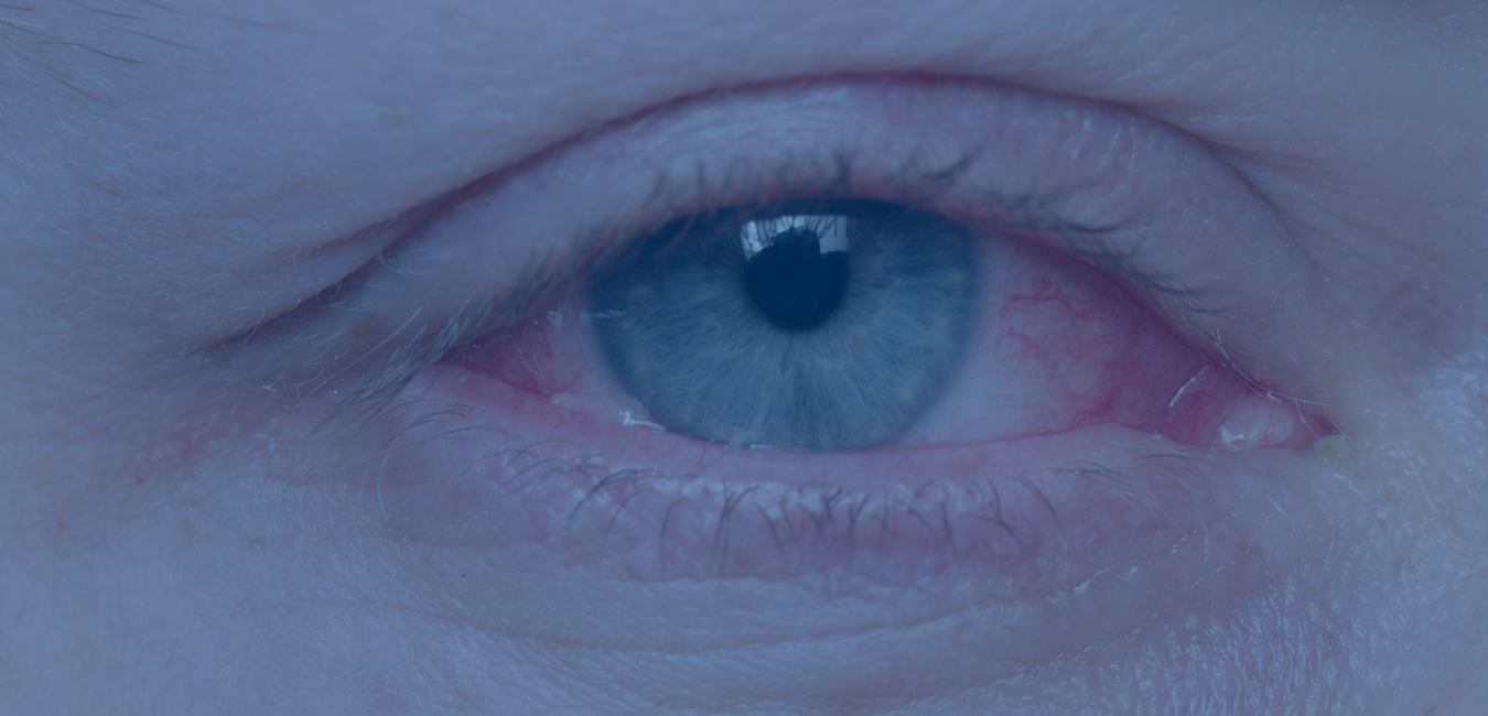 person with blue eye that is swollen and bloodshot