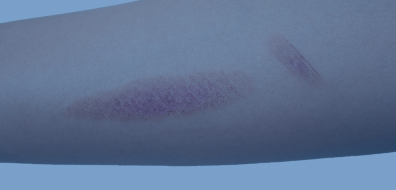 photo of arm with 2 burn marks on it