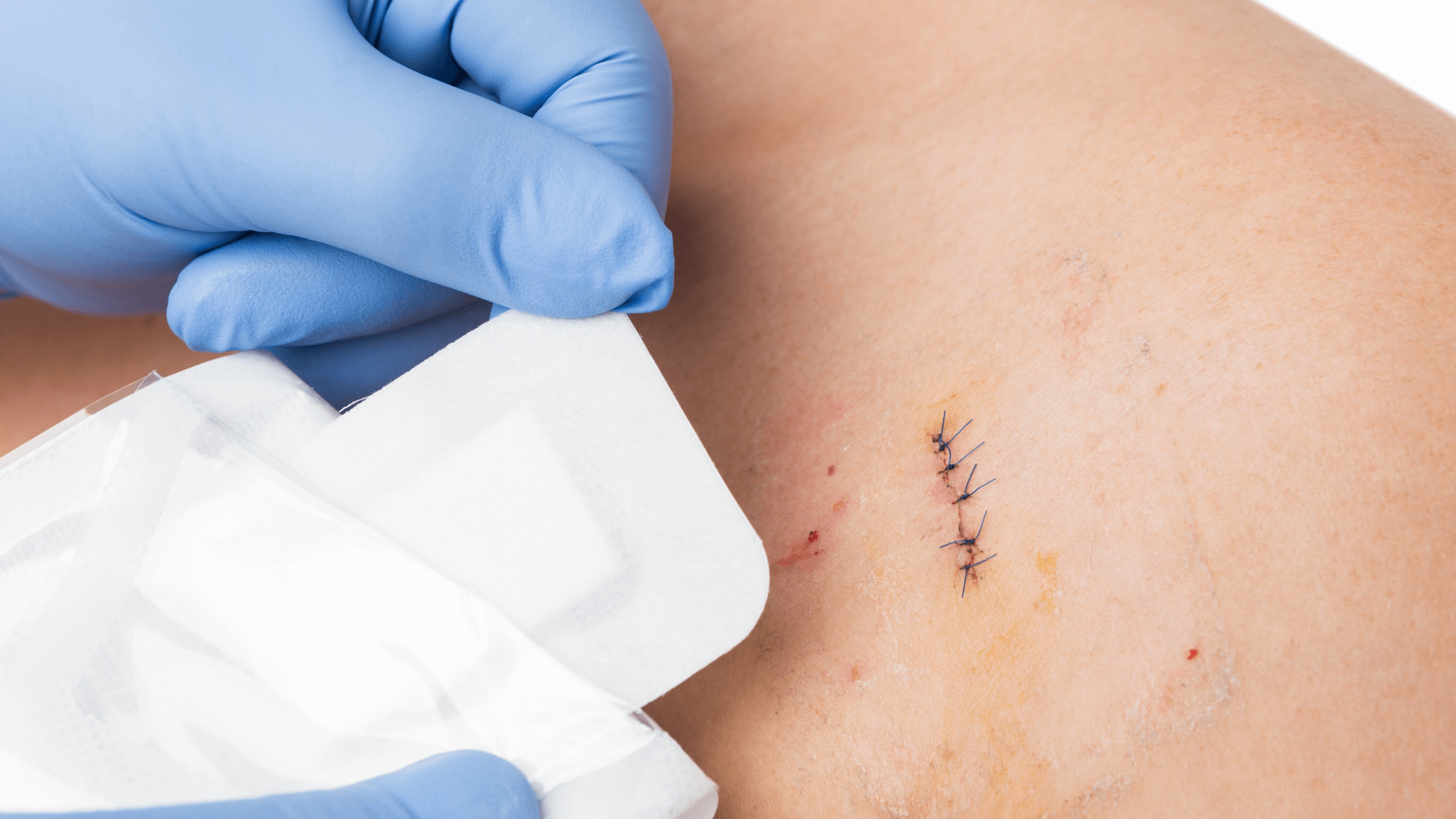 What You Should Do If Your Stitches Start To Itch