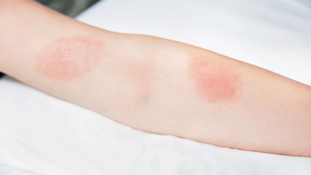 Signs Of Infection Wounds University Urgent Care