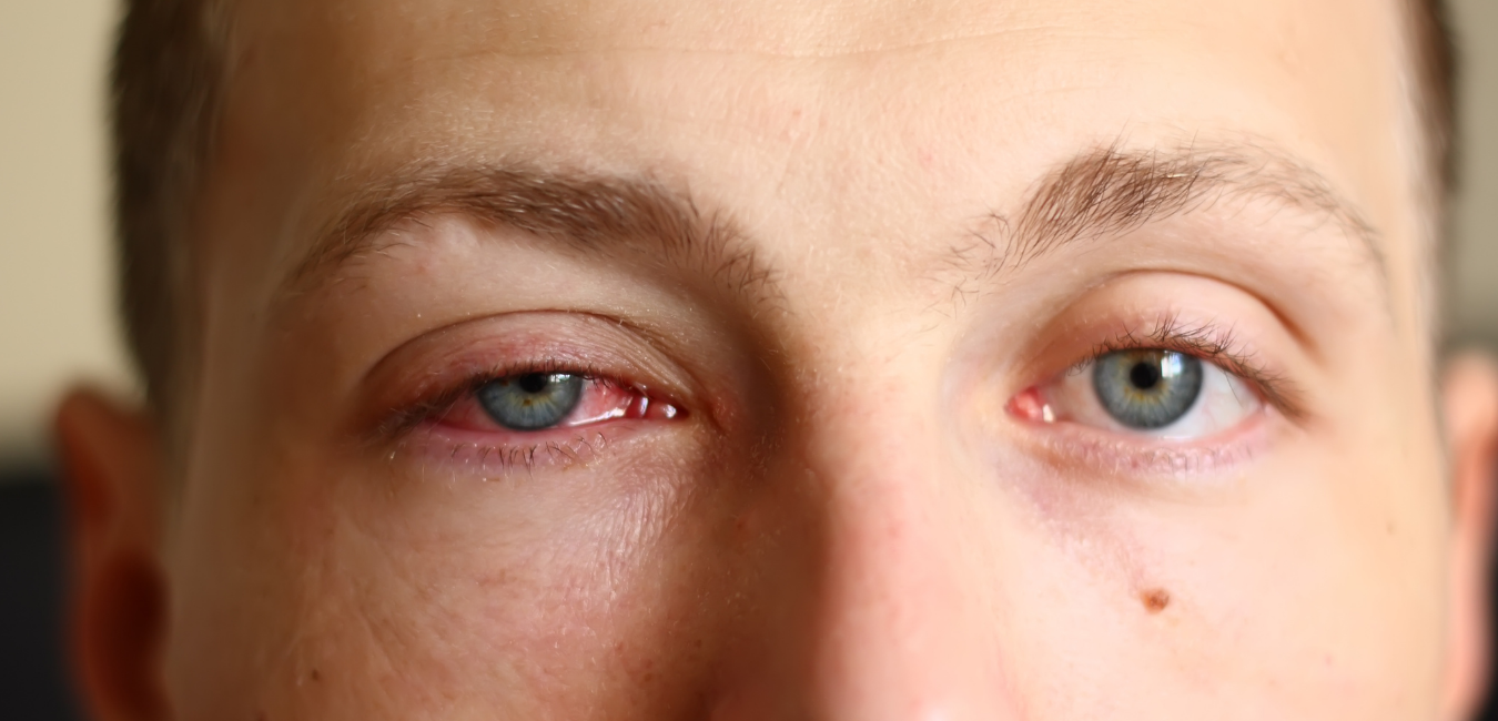 picture showing what is pink eye