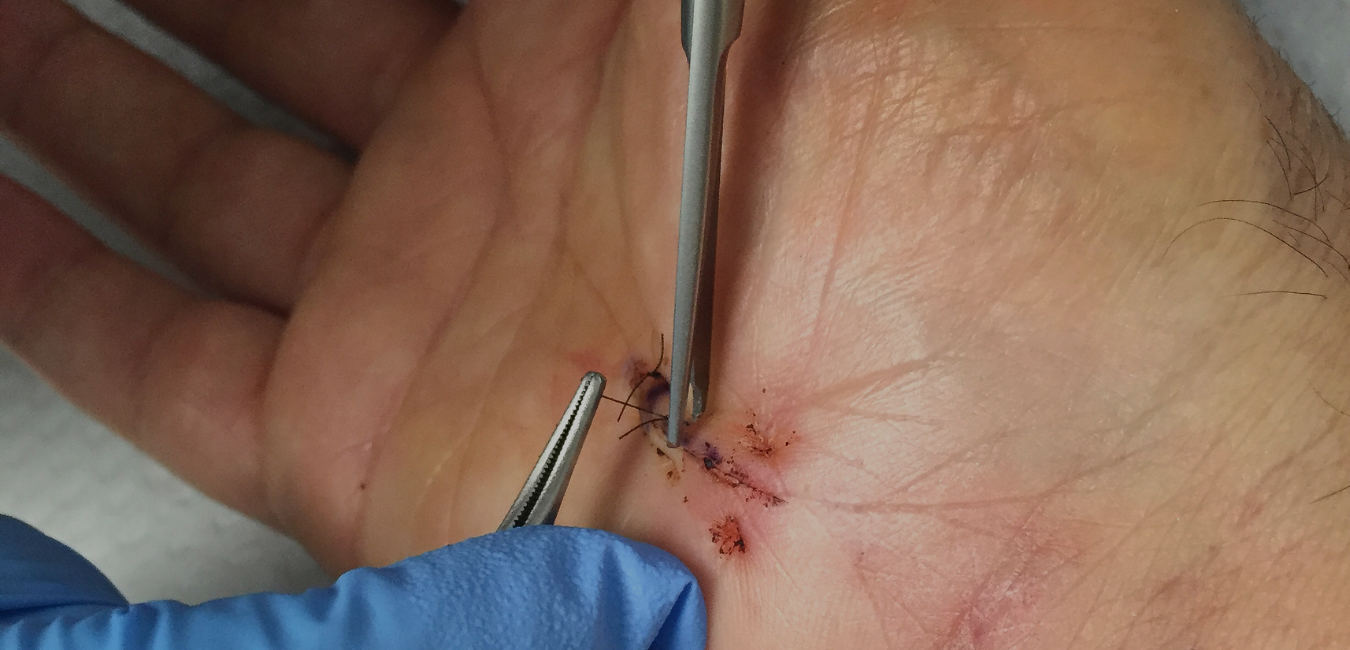 How to Know if a Cut Needs Stitches or Not - University Urgent Care